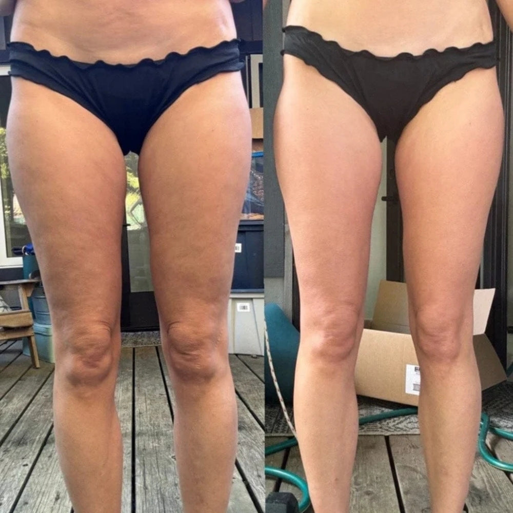 SanaLift™ - Anti-Cellulite Massager